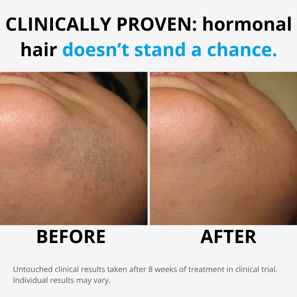 Hairlessly IPL at Home Hair Removal - Halo PRO