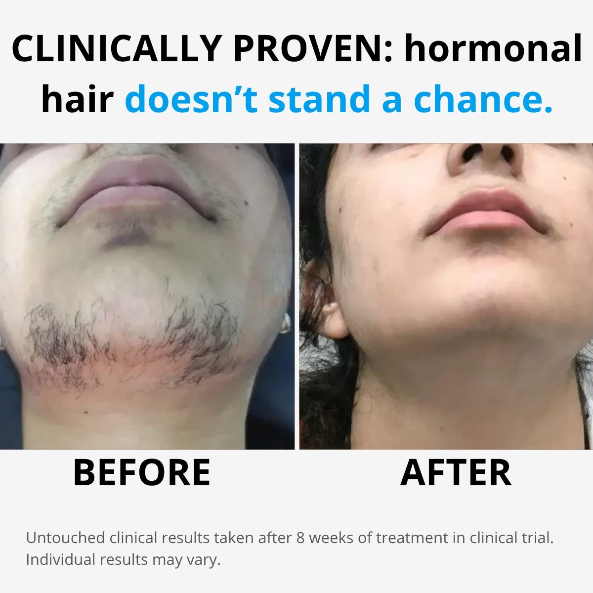 Hairlessly IPL at Home Hair Removal - Halo PRO