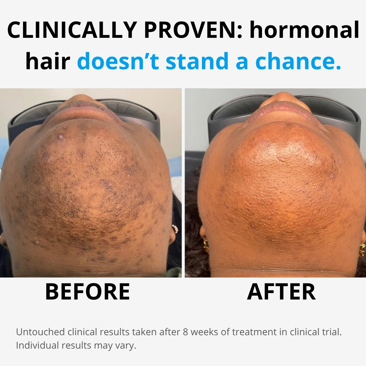 Hairlessly IPL at Home Hair Removal - Halo PRO